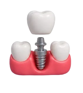Dental Implants