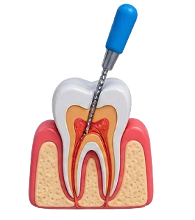 Root Canal Treatment